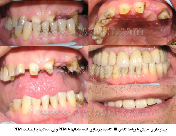 سایش دندان ها - بازسازی کامل دهان