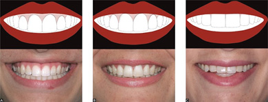دندانپزشکی - طرح لبخند