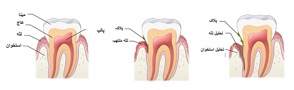 دندانپزشکی - پریو