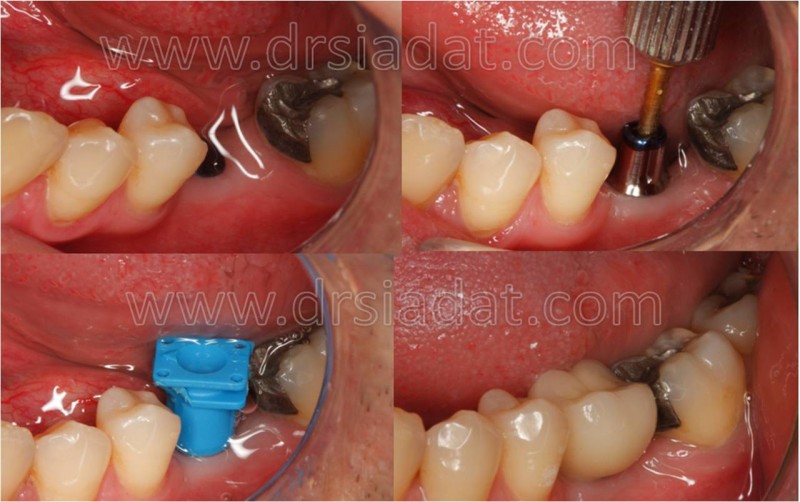 Posterior implant in mandible