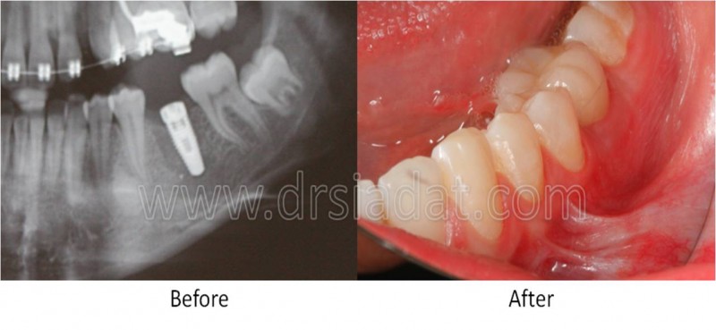Posterior implant in mandible
