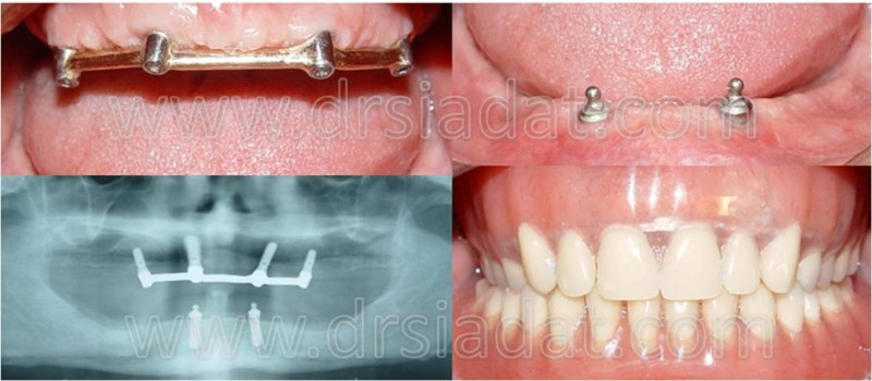 Maxillary and mandibular implant overdenture