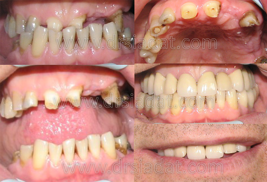بیمار دارای سایش با روابط کلاس ||| کاذب بازسازی کلیه دندانها با PFM  و بی دندانیها با ایمپلنت PFM