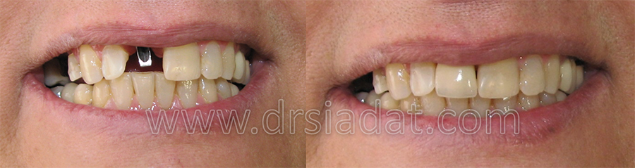 بازسازی دندان قدامی (سانترال) از دست رفته با ایمپلنت