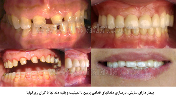 بازسازی دندان های قدامی