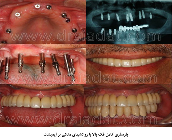 بازسازی کامل فک بالا با روکشهای متکی بر ایمپلنت