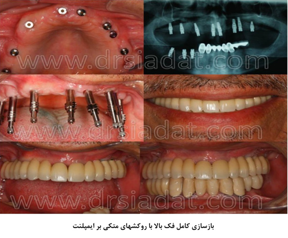 بازسازی کامل فک بالا با روکش های متکی بر ایمپلنت