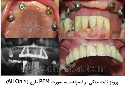 پروتز ثابت متکی بر ایمپلنت به صورت PFM طرح 