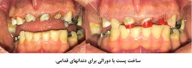 ساخت پست با دورالی برای دندانهای قدامی