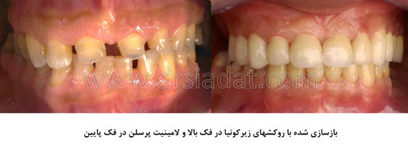 بازسازی دندانها با روکشهای زیرکونیا و لامینیت پرسلن