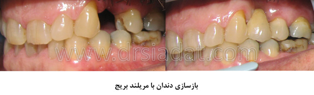 بازسازی کامل دندان با مریلند بریج