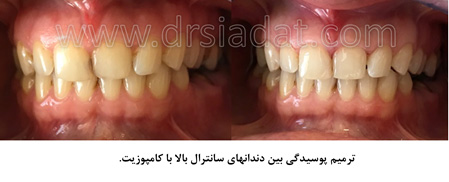 ترمیم پوسیدگی دندان