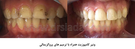 کامپوزیت همراه با ترمیم دندان