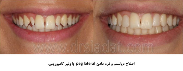 اصلاح فرم دندان