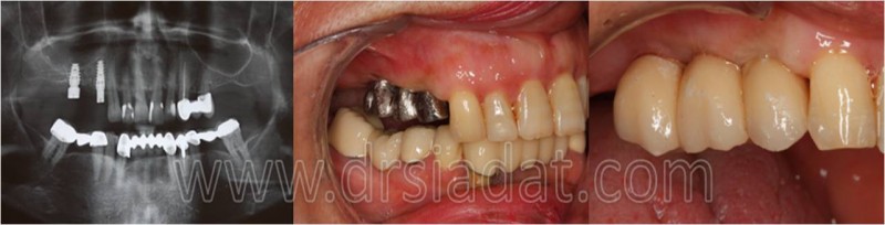 Posterior implant in Maxilla