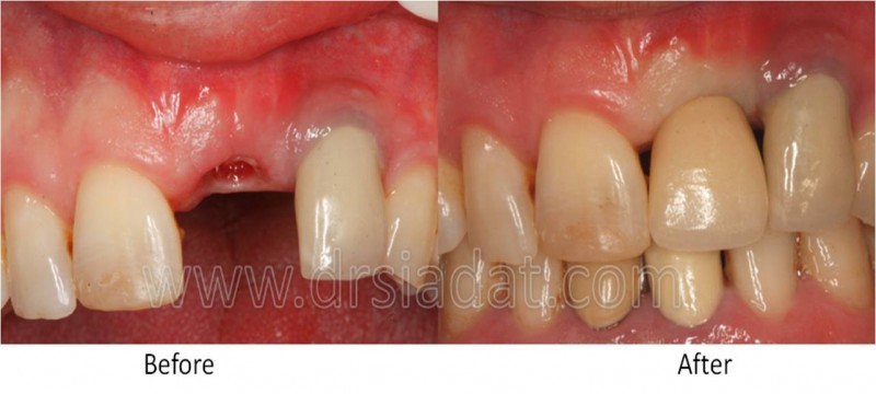 درمان ایمپلنت در ناحیه قدامی فک بالا (بلافاصله پس از تحویل)