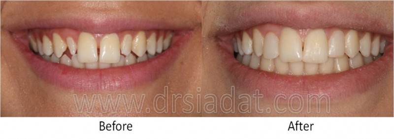 Patient with diastema