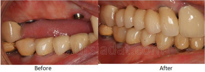 Posterior implant in Maxilla