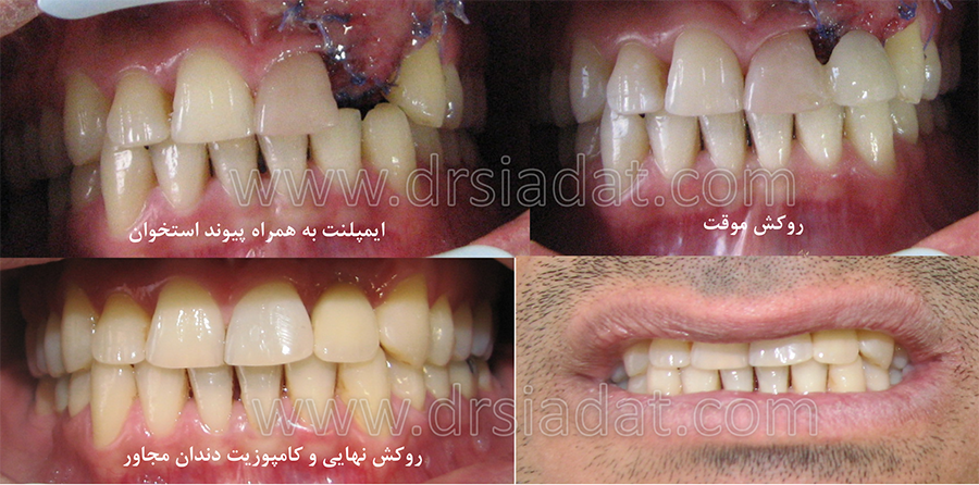 بازسازی دندان قدامی (لترال) از دست رفته با ایمپلنت.