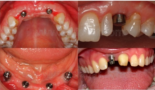 implant1